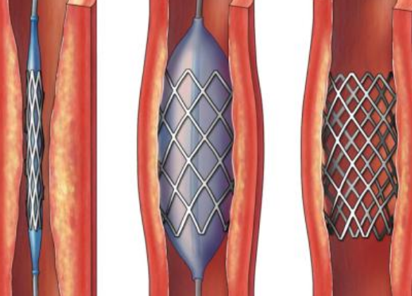 好消息！700元冠脈支架來(lái)了帶量采購(gòu)結(jié)果在甘肅省正式落地執(zhí)行
